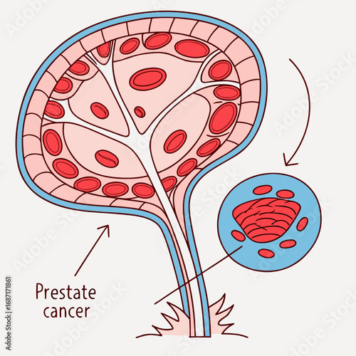 Medical illustration of breast anatomy showing the progression of ductal carcinoma, comparing healthy and cancerous ducts