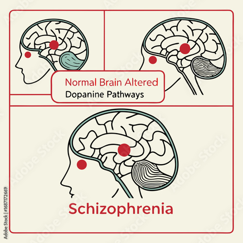 Brain Pathways in Schizophrenia