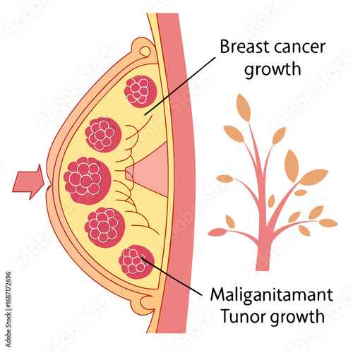 Understanding Breast Cancer A Visual Guide