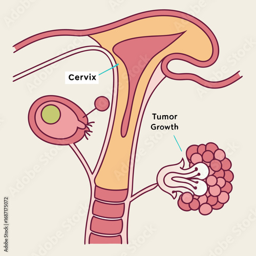 Uterus and Cervix with Tumor Growth Anatomy