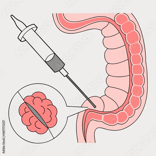 Colon Cancer Injection Treatment Illustration