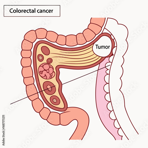 Colorectal Cancer Tumor Growth Illustration