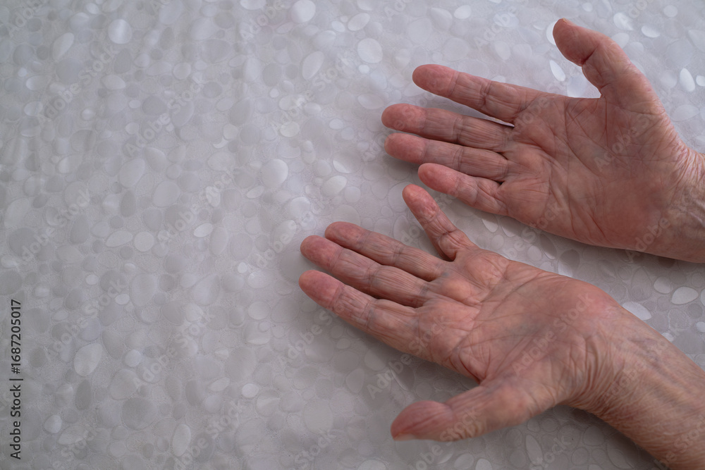 Fototapeta premium Elderly man showing hands affected by neuromuscular disease.