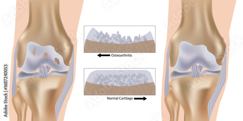 Medical illustration of knee osteoarthritis and normal cartilage. Cartilage Degeneration in Osteoarthritis. Anatomical diagram showing knee joint damage in osteoarthritis