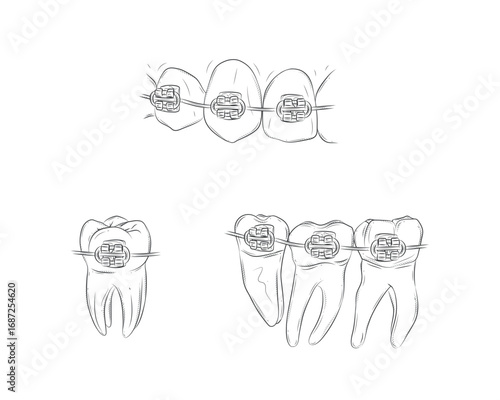 Teeth with braces set illustration drawing in graphic style with black on white background.
