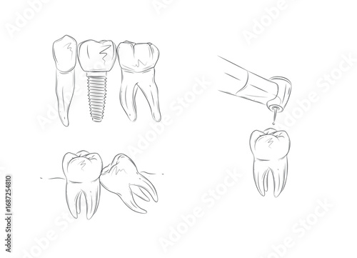 Drill the tooth with dental machine, implant, remove sick teeth illustrations drawing in graphic style with black on white background.