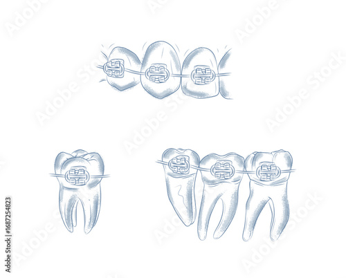 Teeth with braces set illustration drawing in graphic style with blue on white background.