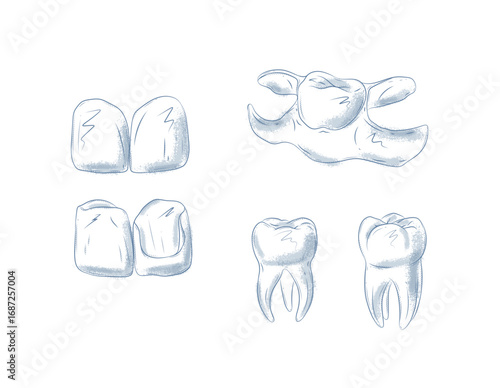 Dental veneers on teeth and dentist tool drawing in graphic style with blue on white background