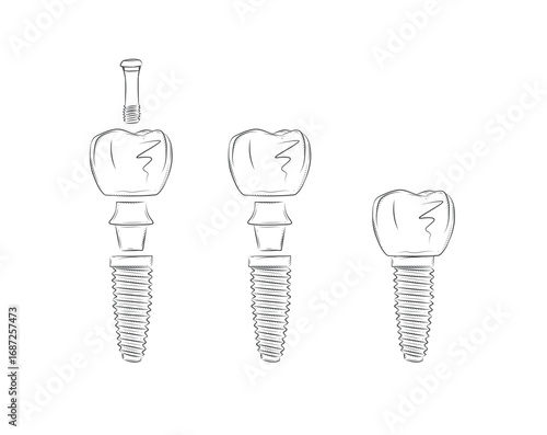 Tooth implant parts illustration drawing in graphic style with black on white background.