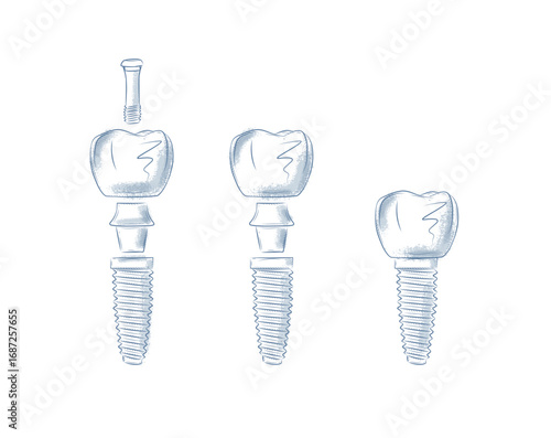 Tooth implant parts illustration drawing in graphic style with blue on white background.