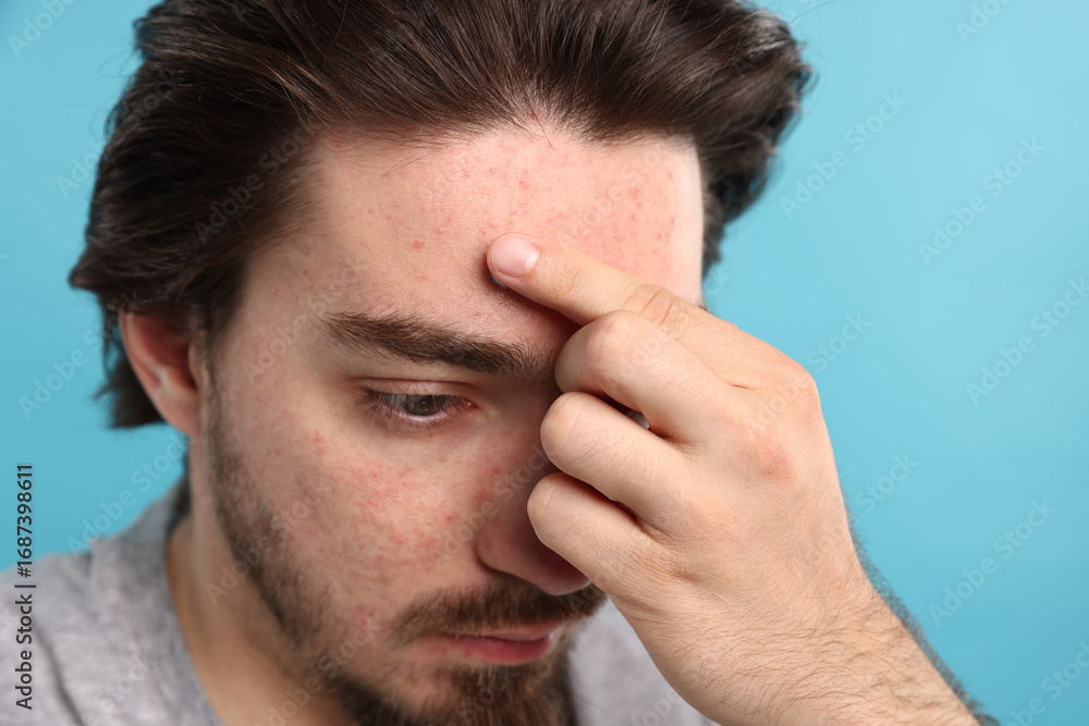 Fototapeta premium Young man with acne problem on light blue background, closeup