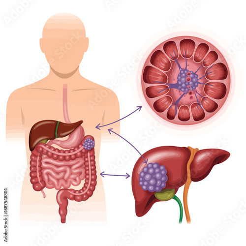 Illustration of human liver cancer and tumor growth in the digestive system
