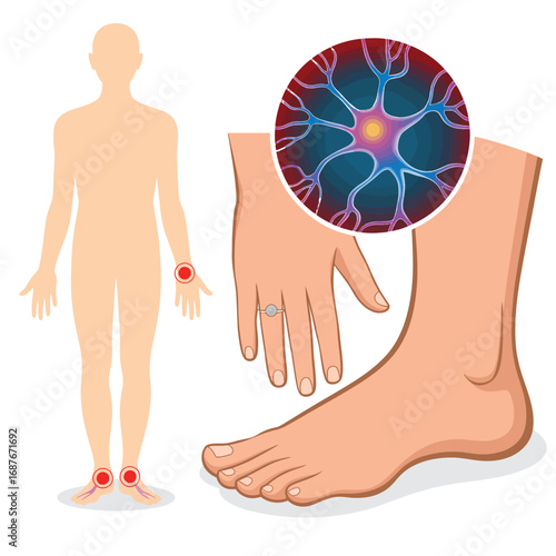 Human body illustration showing nerve endings in hands and feet with a magnified neuron