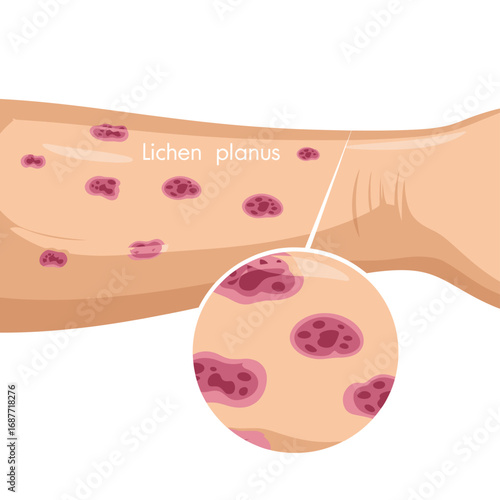 Close up view of skin rash with magnified view showing inflamed red spots