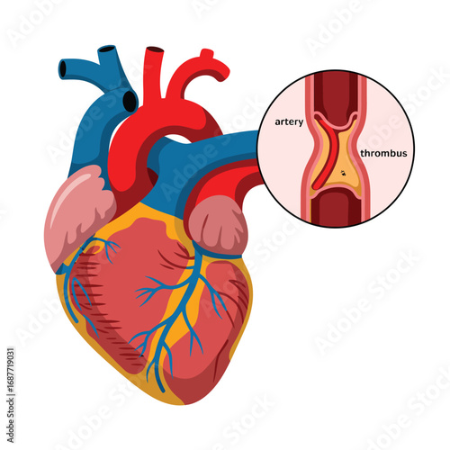 Human heart anatomy with arterial plaque buildup illustration