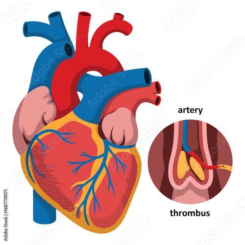 Human heart anatomy with artery thrombus illustration