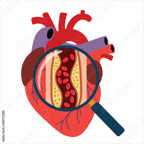 Magnified view of a human heart showing a blocked artery with plaque buildup