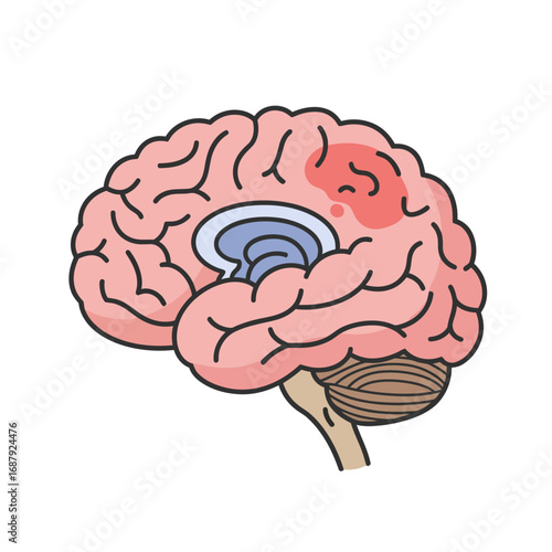 brain stroke illustration showing hemorrhage on cerebrum affecting function and health for medical content