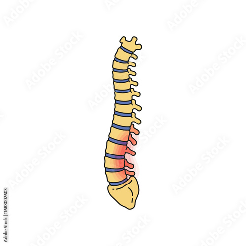 scoliosis spine pain showing a curvature deformity of the spine illustrating medical anatomy and healthcare issues