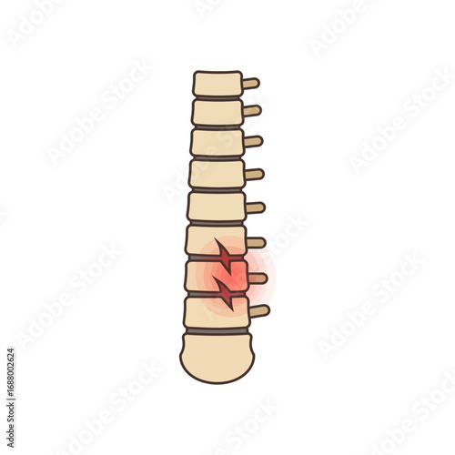 spinal compression fracture showing vertebral damage resulting in pain ideal for medical education material