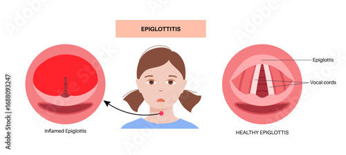 Epiglottitis medical poster