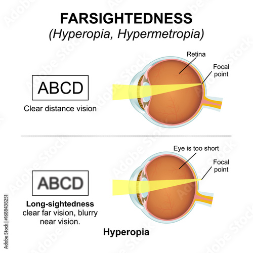 Hyperopia  Hypermetropia - Farsightedness Eye Flashcard Illustration