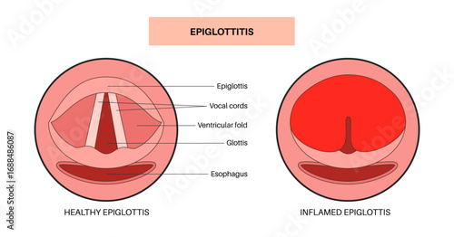 Epiglottitis medical poster