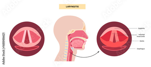 Laryngitis medical poster