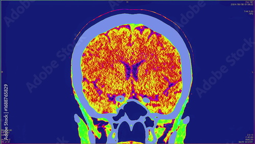 Magnetic resonance color images of the brain, top view, MRI of the brain, of a patient with multiple vascular infarctions, 3x3 image grid, color animation Seamless Loop. High quality 4k footage
