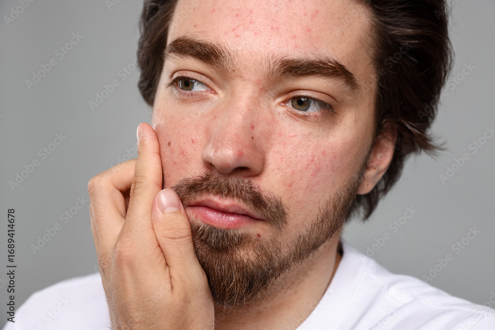 Obraz premium Young man with acne problem applying cream onto his face on light grey background, closeup