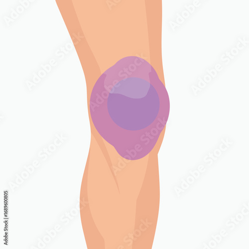 Purple compress on knee for pain relief and injury treatment  