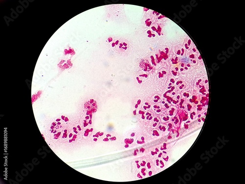 Intracellular Neisseria gonorrhoeae bacteria with gram staining, viewed under a microscope.