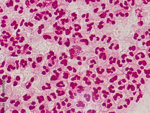 Intracellular Neisseria gonorrhoeae bacteria with gram staining, viewed under a microscope.