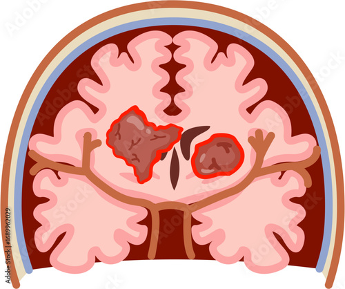 Glioma