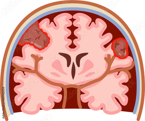 Meningioma