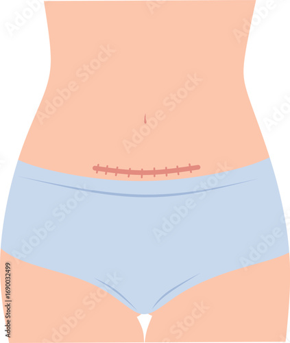 Horizontal cesarean scar. Stitches after a cesarean section on a woman's abdomen