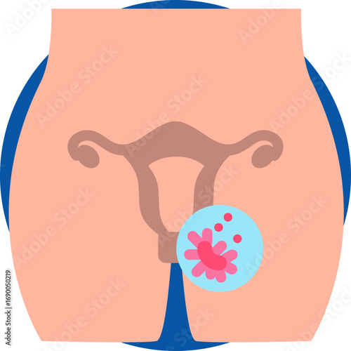 Ovarian cancer icon for cancer diagnosis, website, application, printing, document, poster design, etc