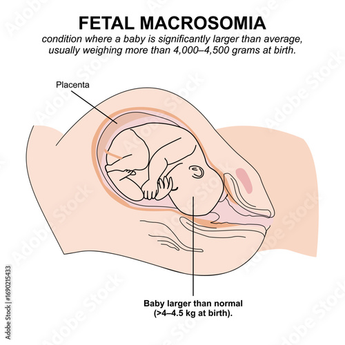 Fetal Macrosomia medical flashcard illustration