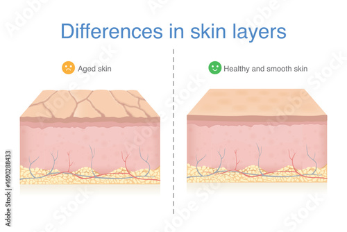 Differences of skin layer between Aged skin by deep wrinkles and dryness and healthy and smooth skin layer. Problems in epidermis and dermis from aging.