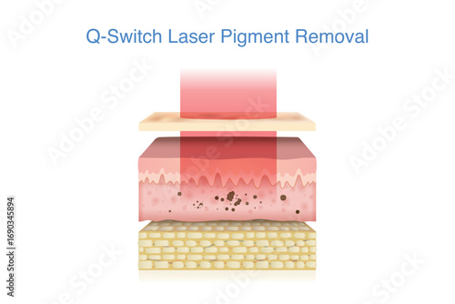 Q Switch laser shatters pigment, fading dark spot on skin layer. Illustration about Derma technology for removing unwanted pigment such as from tattoos, freckles, age spots, and melasma.
