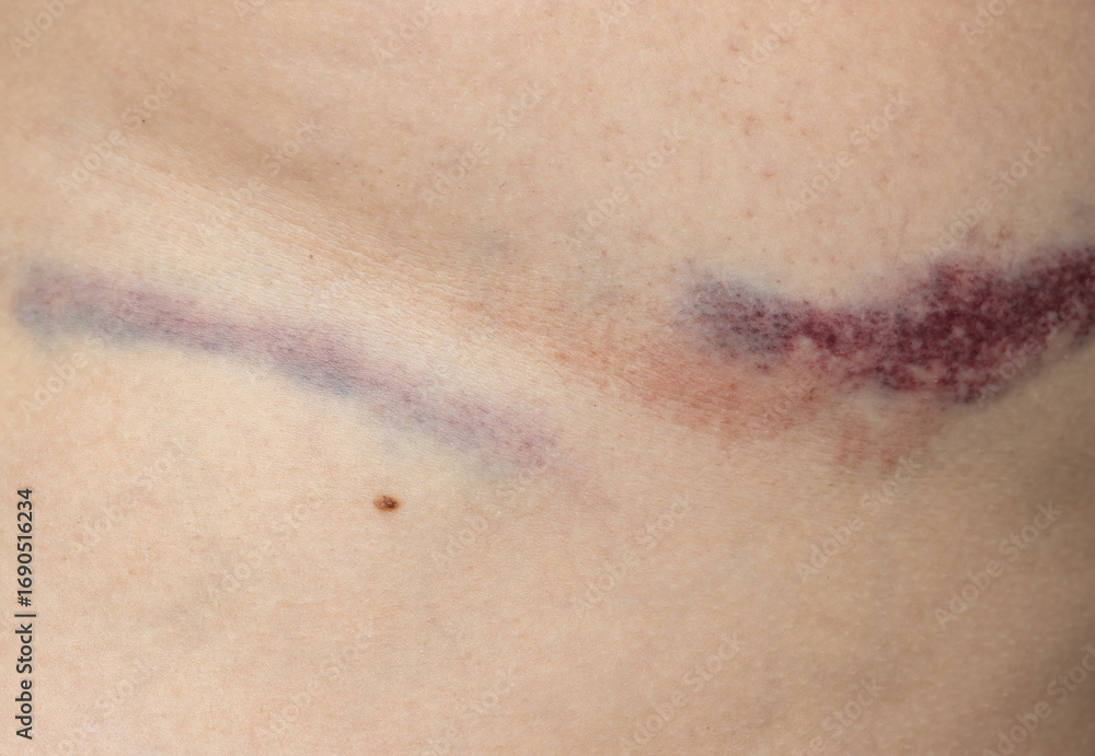 Fototapeta premium A scar on a person's arm