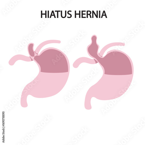 Vector illustration of hiatus hernia showing stomach displacement, heartburn, chest discomfort, reflux, nausea, plus related conditions like GERD and esophagitis.