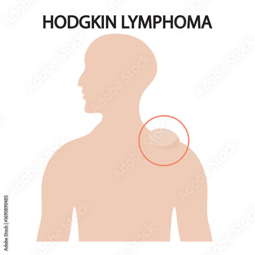 Flat vector illustration of Hodgkin lymphoma highlighting symptoms like swollen lymph nodes, fatigue, fever, night sweats, and similar diseases such as non-Hodgkin lymphoma.
