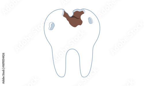 A decayed tooth with a brown cavity.