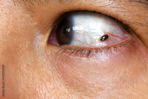 Mole in woman eye. Ocular melanoma in the eye.
