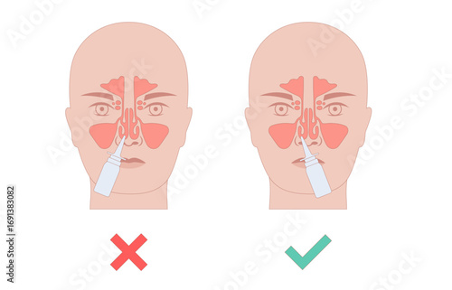 Proper nasal spray usage
