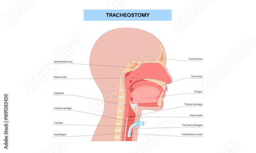 Tracheostomy medical poster