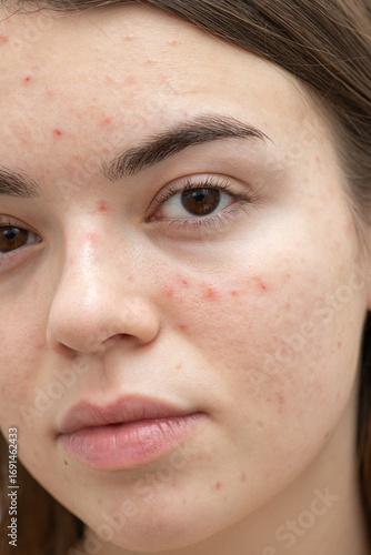 Portrait of young woman with acne on her face, close-up. Acne, skin care concept. Real photo.