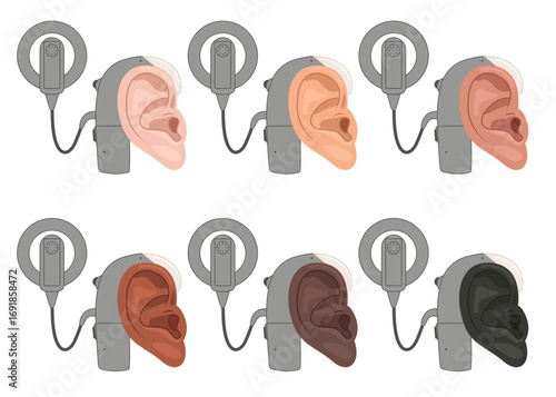 Different skin colors. Ear with cochlear implant device for the hearing impaired and the deaf. Concept hearing aids, treatment of deafness. Flat vector illustration