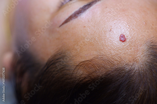 Cherry Angioma on the face.